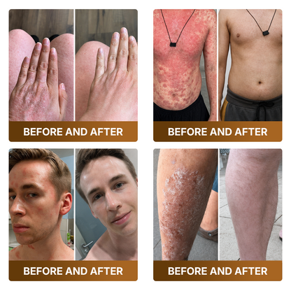 🛒 An additional 30% discount👑Made and Shipped from UK ✨🔥 DOCTIA® Botox & Bee Venom Advanced Recovery Cream—For Wrinkles, Sagging Skin, Skin Tags & Rough Bumps
