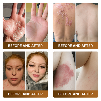 🛒 An additional 30% discount👑Made and Shipped from UK ✨🔥 DOCTIA® Botox & Bee Venom Advanced Recovery Cream—For Wrinkles, Sagging Skin, Skin Tags & Rough Bumps