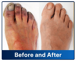 ✅Gout — Complete Solution
